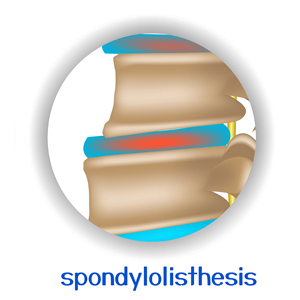 picture of Fort Wayne chiropractic spondylolisthesis